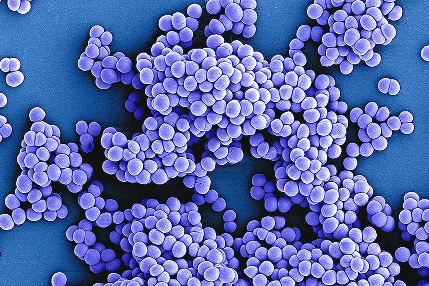 L'aztréonam dans le traitement des infections à microsporidies